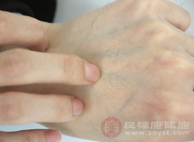 湿疹的常见症状就是皮肤瘙痒