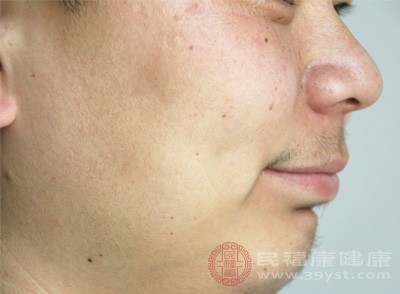黄疸是肝脏功能异常或者肝变硬的一个明显标志，也是常见的头面部求救信号之一
